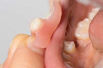 Partial Denture