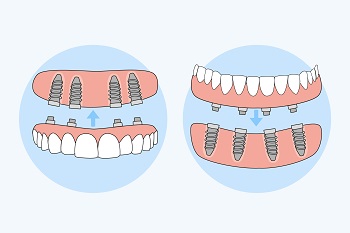 Implant Retained Upper Denture