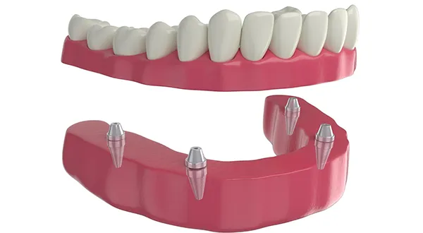 Understanding Implant Dentures