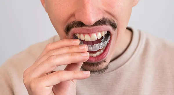 Invisalign Treatments: An Overview 