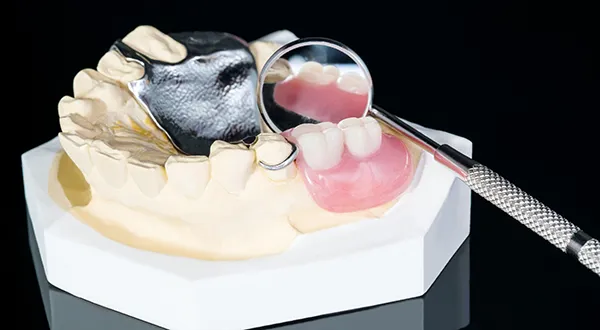 Types of Implant Dentures