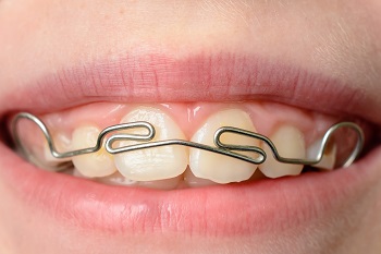 Braces