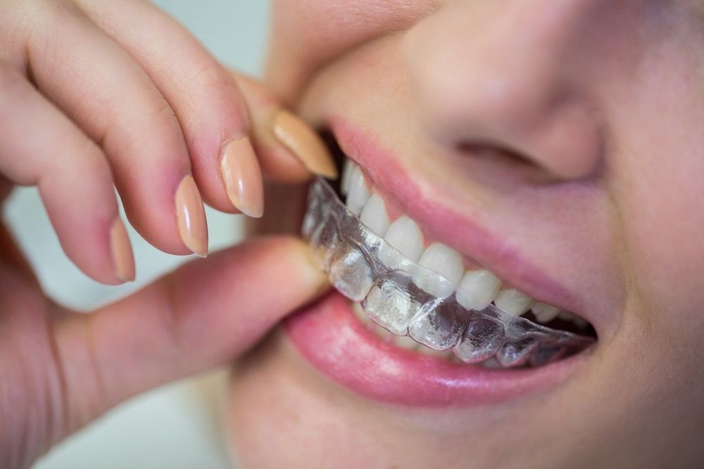 Process of getting Invisalign and what to expect during treatment.